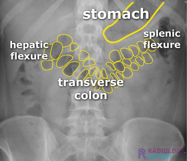 Abdominal Xray